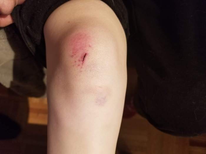Another image of injuries Megan Carter said she sustained when a Hamilton police officer allegedly shoved her.