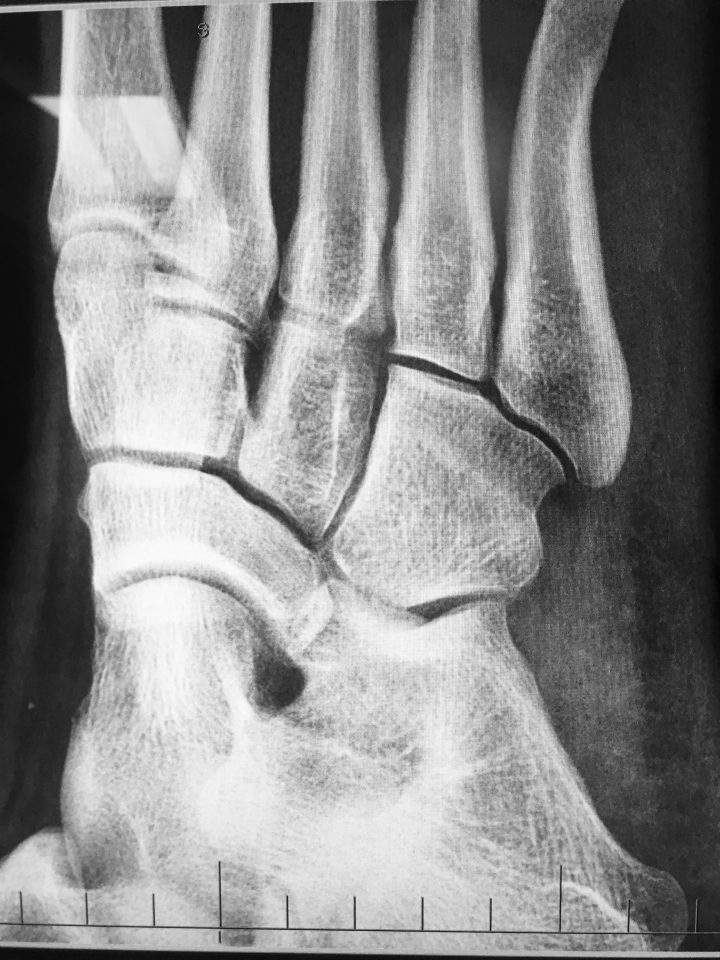 Stress fracture on Furlan’s foot.