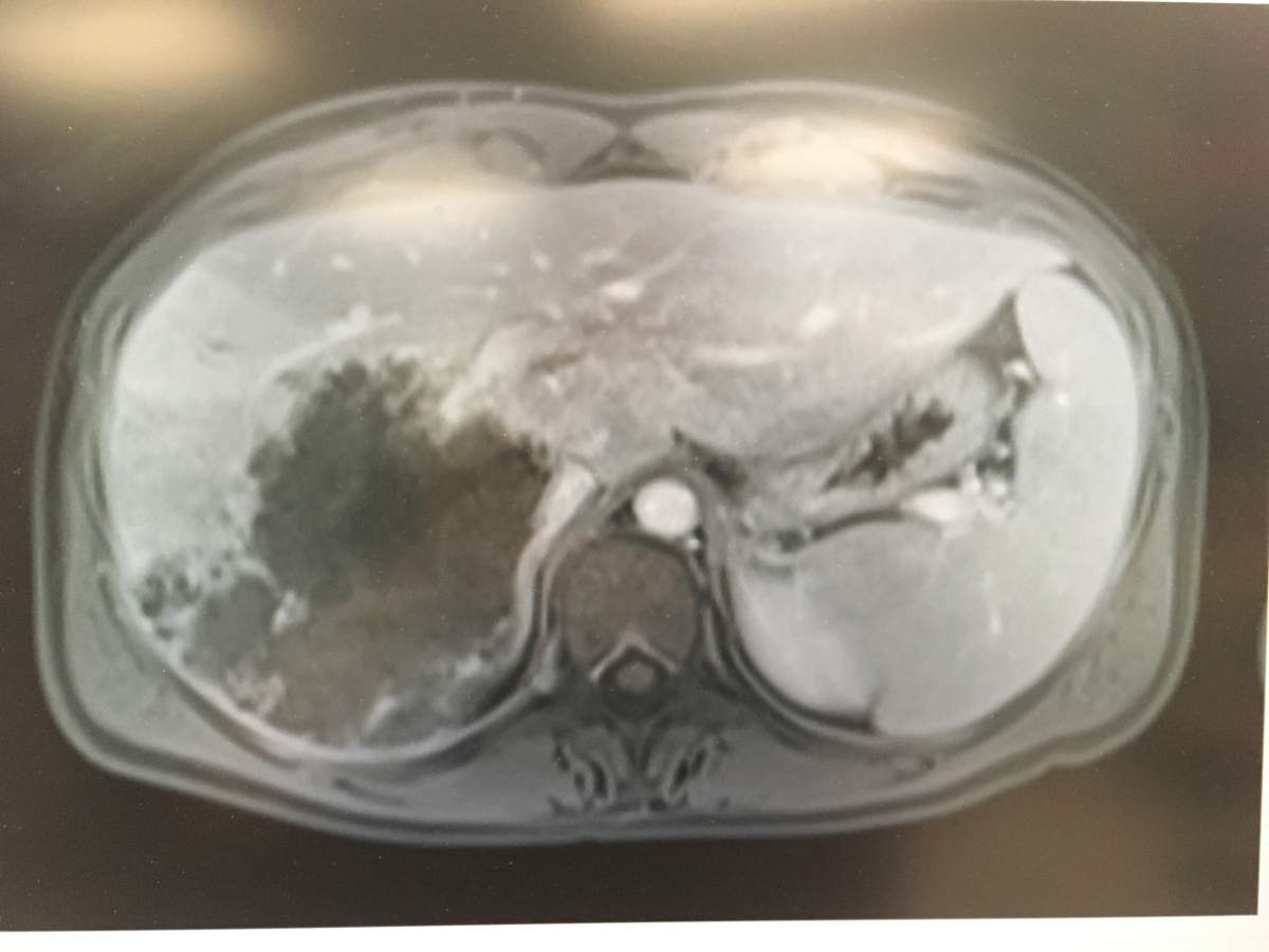 Magnetic resonance image of large, dark mass in Armstrong’s liver.