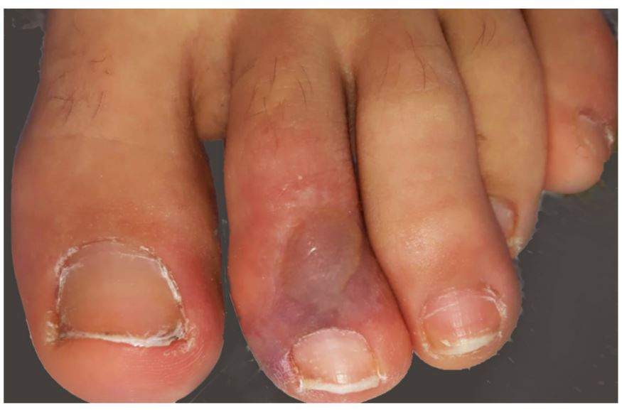 A photo of a blistered toe taken from an Italian case report of a teenager with COVID-19.