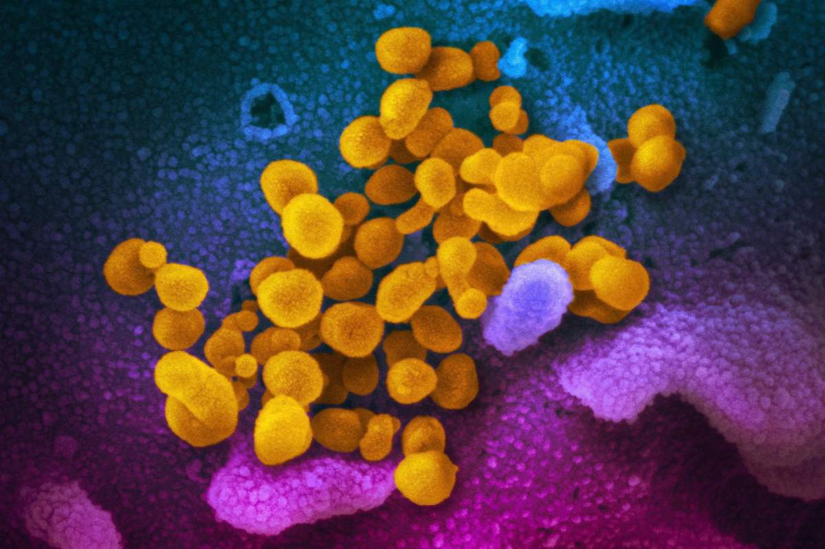 This undated electron microscope image made available by the U.S. National Institutes of Health in February 2020 shows the Novel Coronavirus SARS-CoV-2, yellow, emerging from the surface of cells, blue/pink, cultured in the lab. Also known as 2019-nCoV, the virus causes COVID-19. 