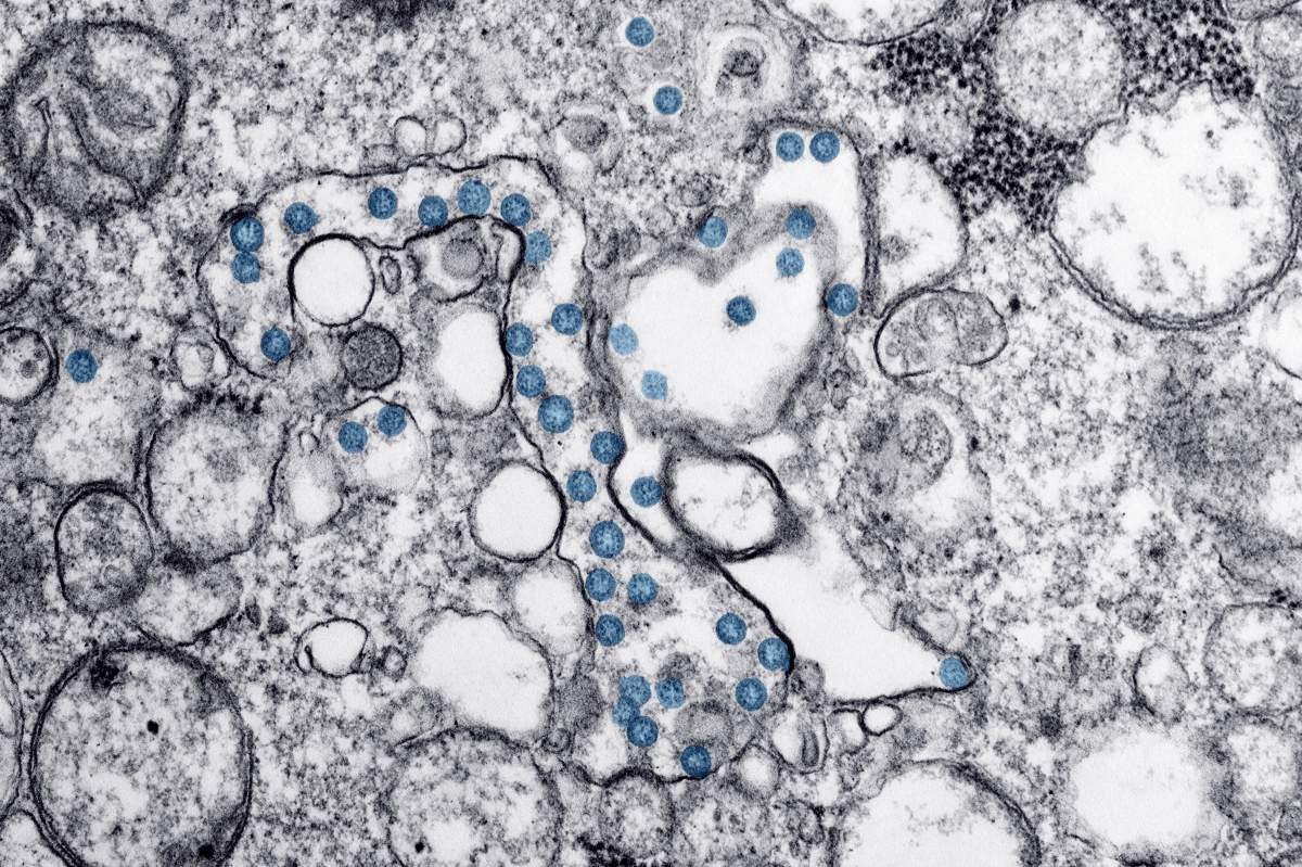 Transmission electron microscopic image of an isolate from the first U.S. case of COVID-19.