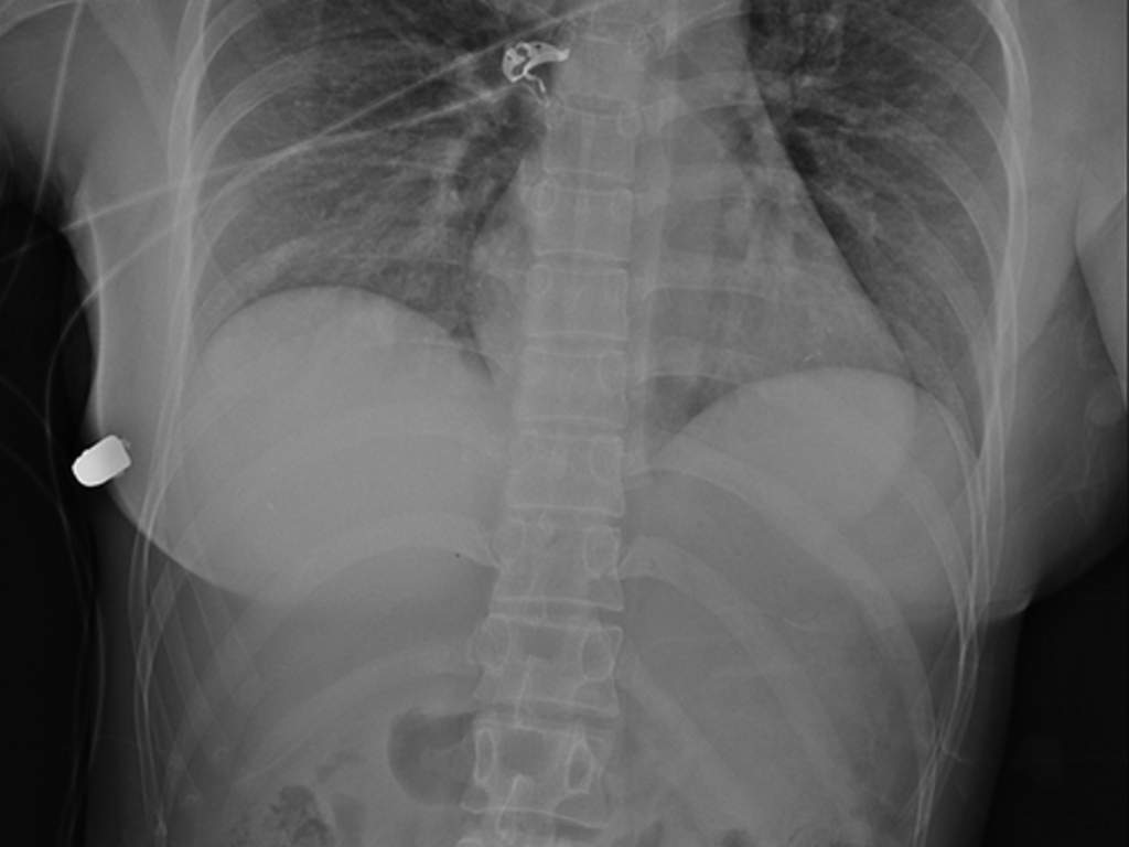 A case study published by Sage Journals on Tuesday says a 30-year-old Ontario woman was saved by her breast implant after suffering a gunshot wound to her chest.