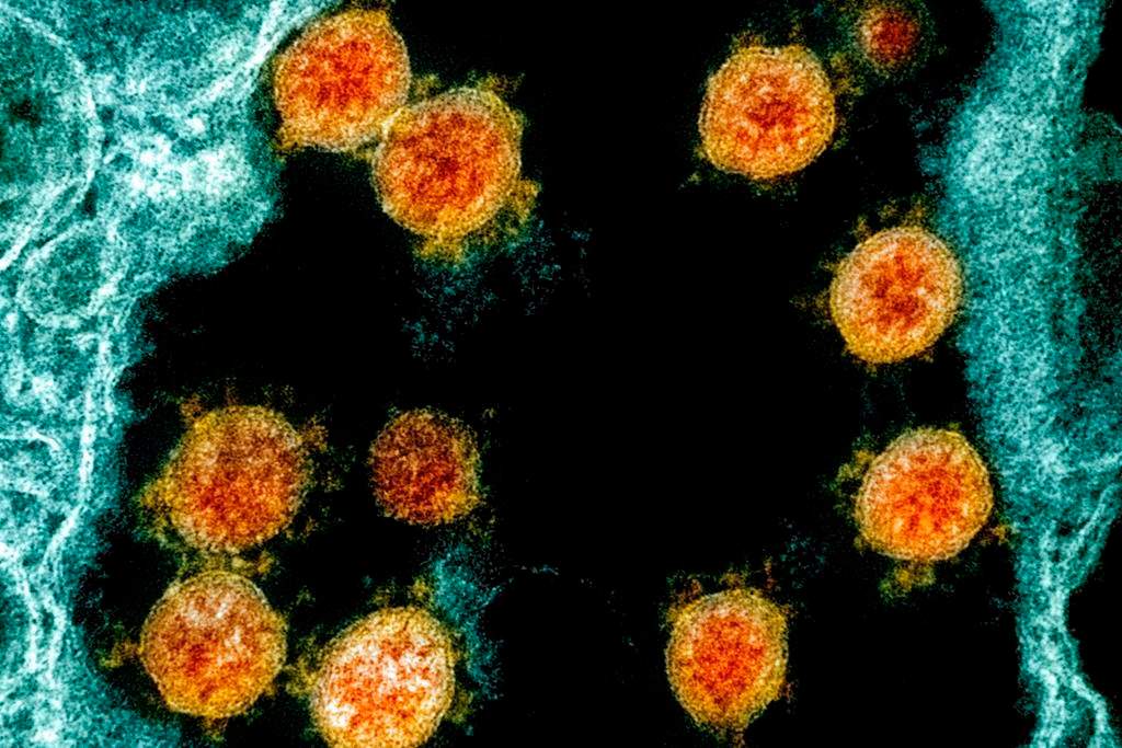 This electron microscope image made available and color-enhanced by the National Institute of Allergy and Infectious Diseases Integrated Research Facility in Fort Detrick, Md., shows Novel Coronavirus SARS-CoV-2 virus particles, orange, isolated from a patient.