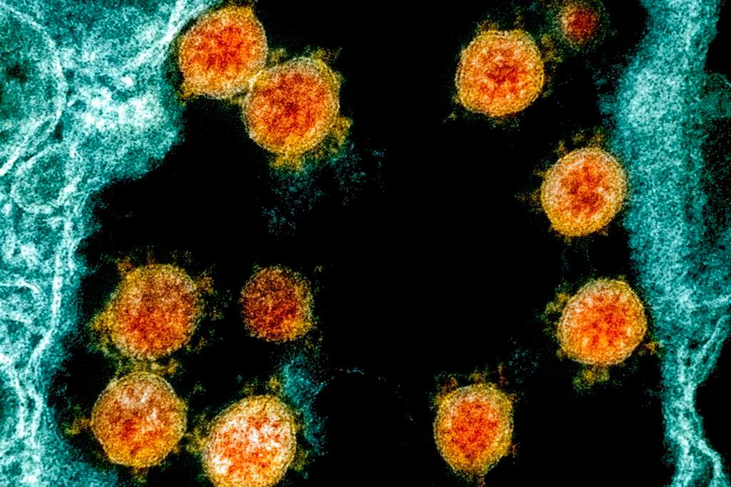 This electron microscope image made available and color-enhanced by the National Institute of Allergy and Infectious Diseases Integrated Research Facility in Fort Detrick, Md., shows Novel Coronavirus SARS-CoV-2 virus particles, orange, isolated from a patient.