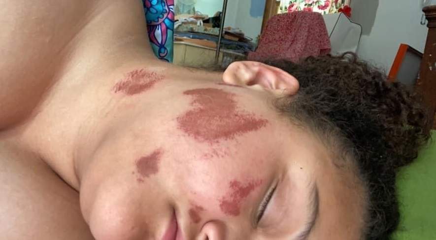 Althea Bernstein’s facial injuries are shown after an alleged lighter fluid attack in Madison, Wis., on June 24, 2020.