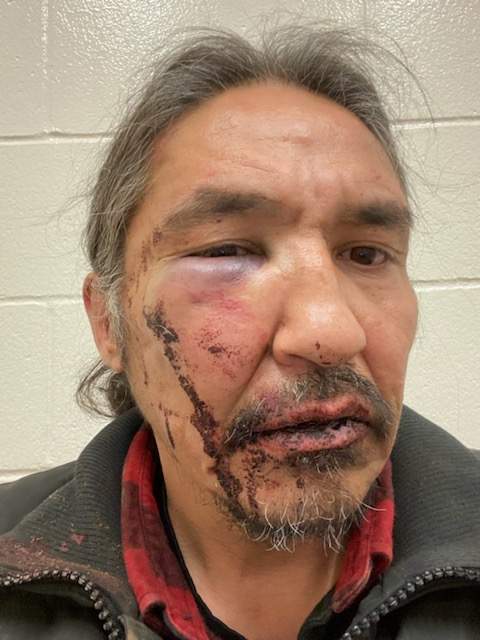 Chief Allan Adam of the Athabascan Chipewyan First Nation will say Saturday these lacerations and bruises were the result of a beating from RCMP officers in Fort McMurray, Alta.