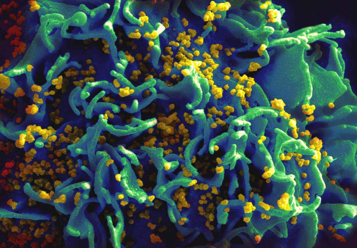 Scanning electron micrograph of HIV particles infecting a human immune cell.