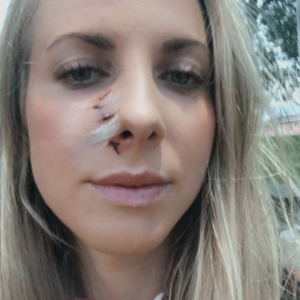 Doctors decided not to stitch the cut over fear of infection.