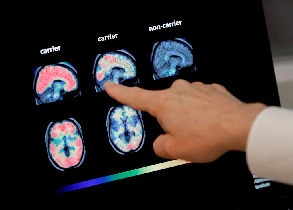 In this file photo, a doctor looks at PET brain scans.