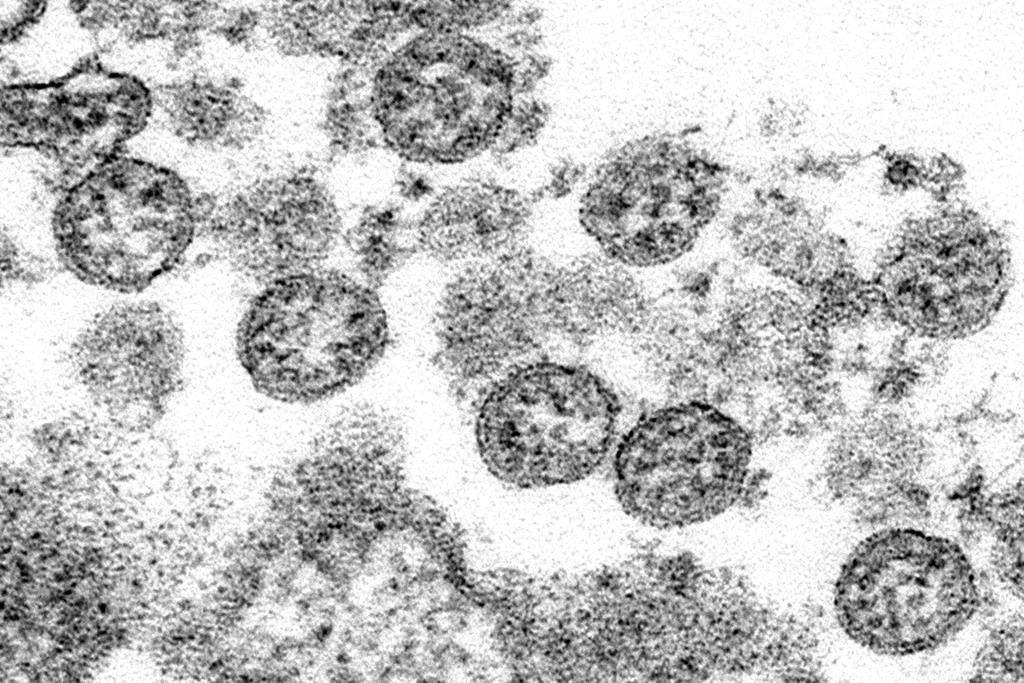 This 2020 electron microscope made available by the U.S. Centers for Disease Control and Prevention image shows the spherical coronavirus particles from the first U.S. case of COVID-19.