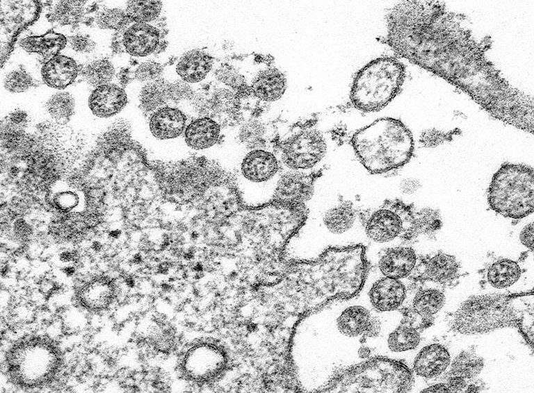 This 2020 electron microscope made available by the U.S. Centers for Disease Control and Prevention image shows the spherical coronavirus particles from the first U.S. case of COVID-19.
