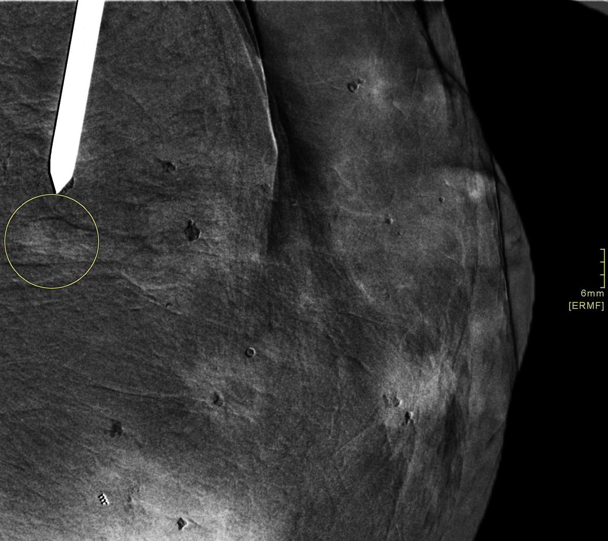 The arrow points to a suspect lesion.