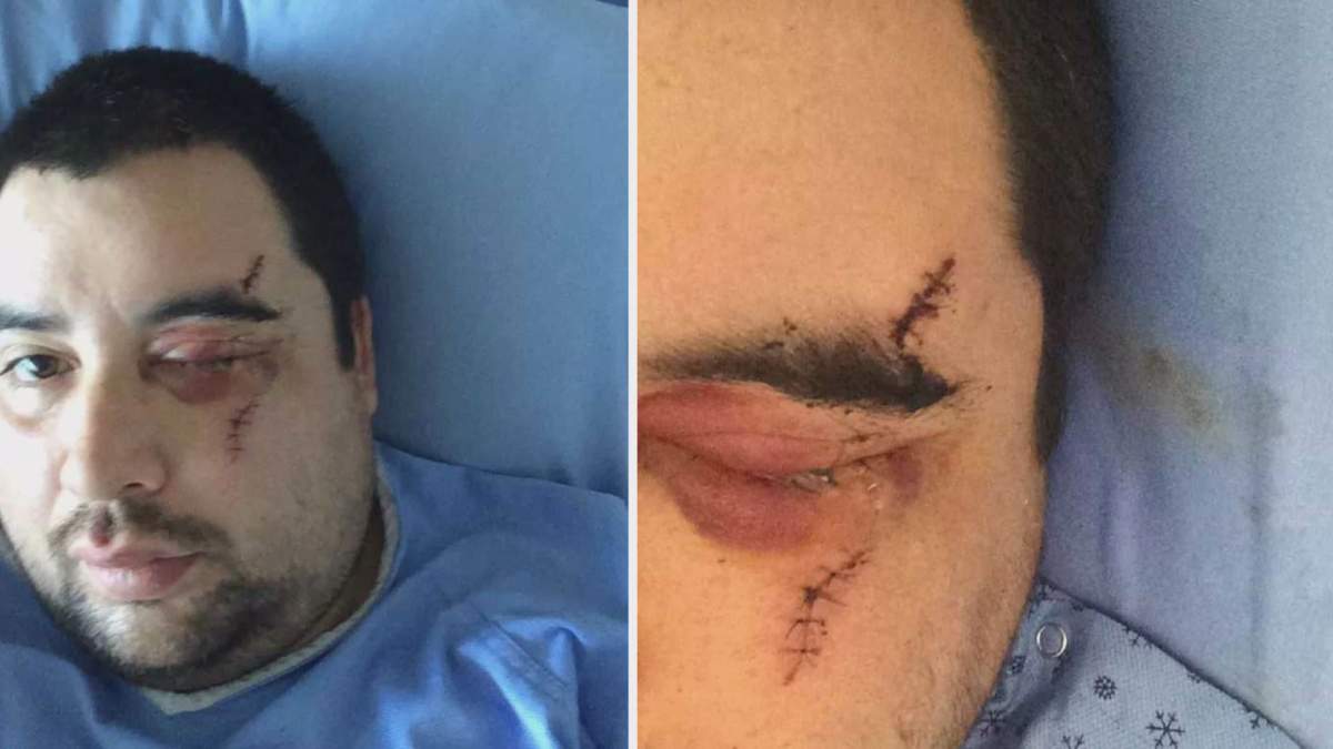 Andrew Ottie took photos of his serious facial injuries on his right eye from his hospital bed days after the attack.