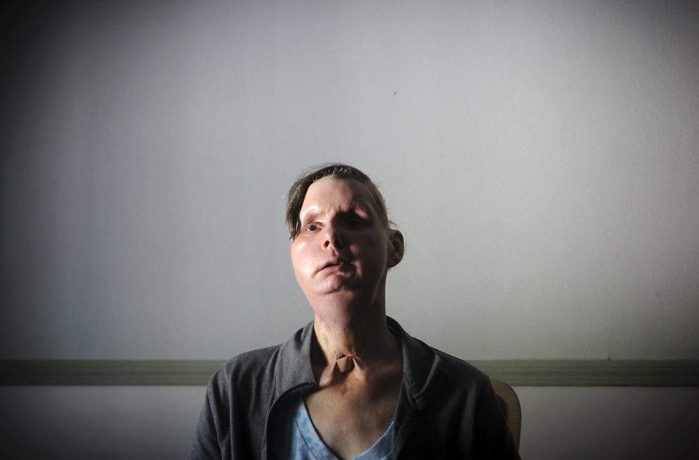 Charla Nash is pictured on March 21, 2012.