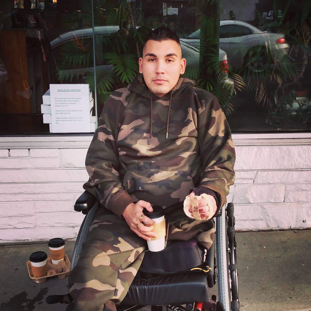 Carl Sinclair in Vancouver after his left leg was amputated. Source: Facebook