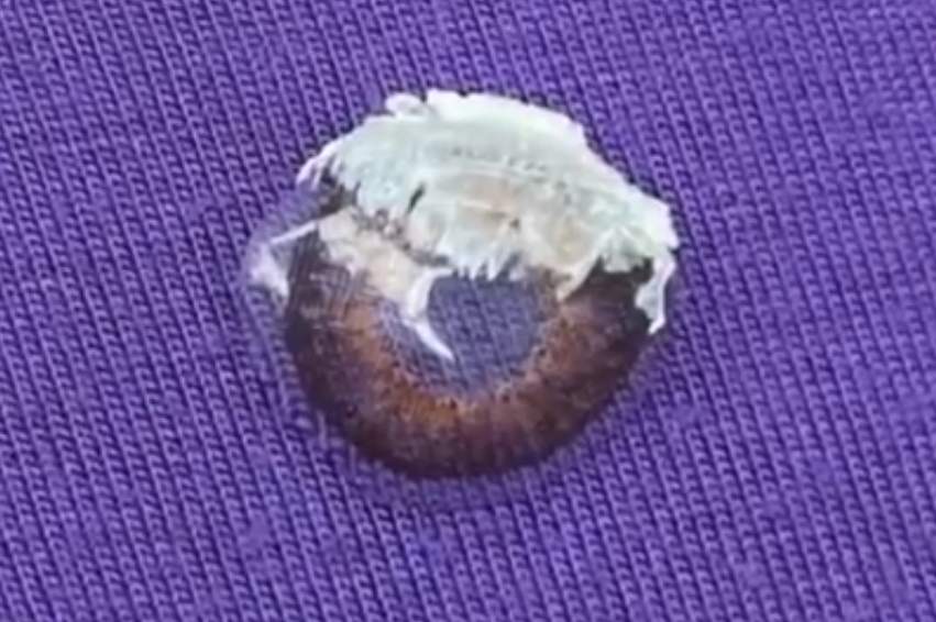 Yacedrah Williams' glue-encrusted contact lens is shown after it was removed from her eye in Michigan in April 2021.