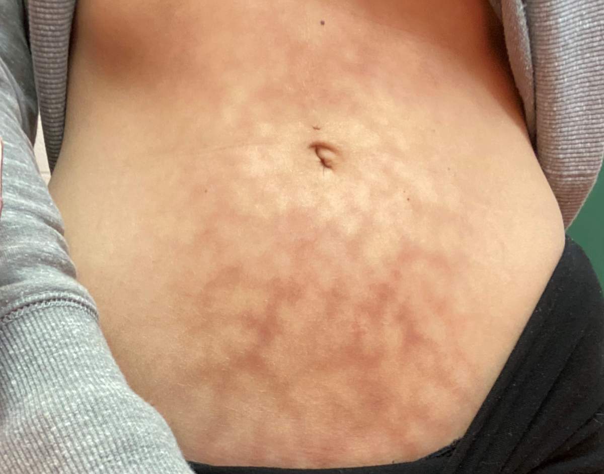 Photo of Sarah’s torso.