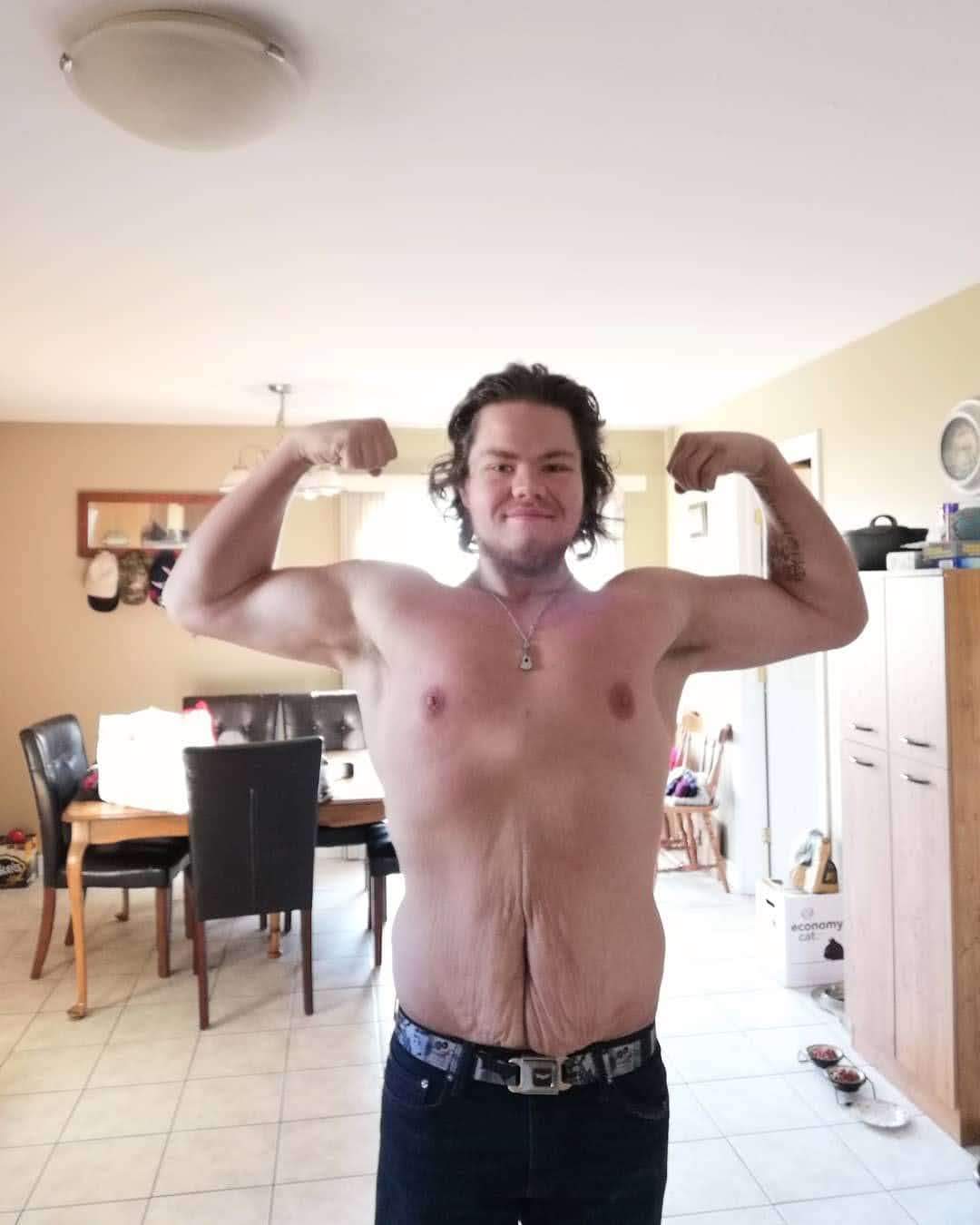 Moncton man asks province to help pay for skin removal surgery after dramatic weight loss - image