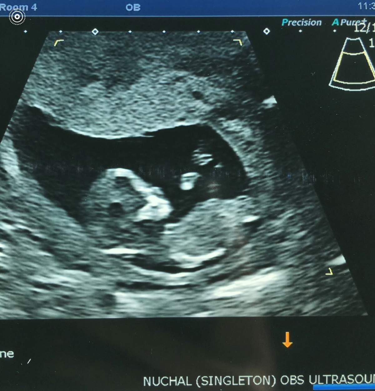 An ultrasound picture of Leslee and Kerri Bossert’s first daughter MacKenzie.