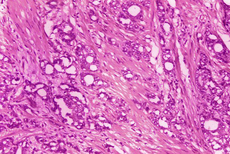 This 1974 microscope image made available by the Centers for Disease Control and Prevention shows changes in cells indicative of adenocarcinoma of the prostate. In results released Thursday, June 3, 2021 by the American Society of Clinical Oncology, doctors are reporting improved survival in men with advanced prostate cancer from an experimental drug that delivers radiation directly to tumor cells. ()
.
