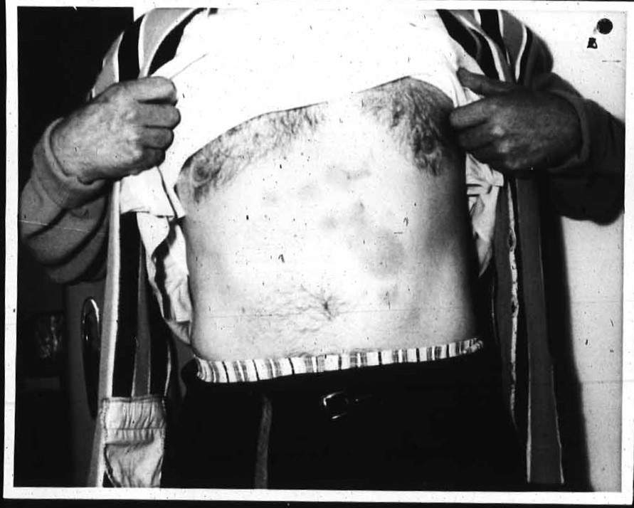 Stefan Michalak claimed to have been burned by the UFO he saw at Falcon Lake, Man., and was treated by a local physician. In this photo from a government archive, he shows burns on his stomach.