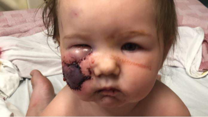RosieMay in the hospital after undergoing a few treatments following the attack.