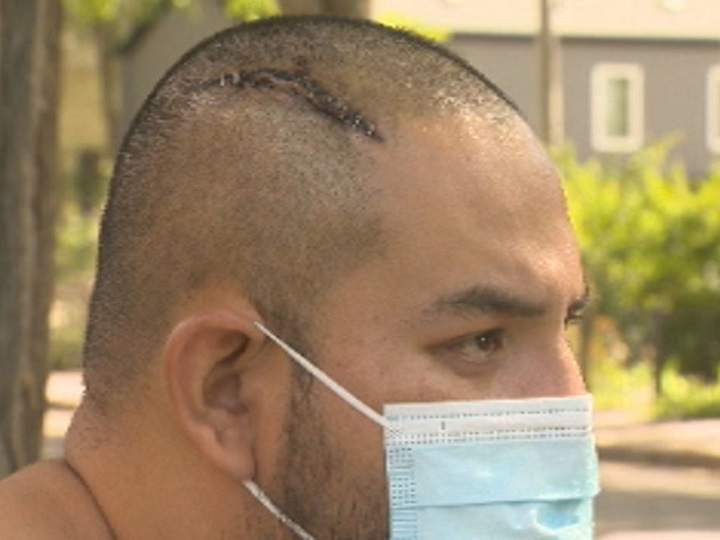 Brett Maxie shows the stitches and staples he received on his head after suffering a gunshot wound during the altercation.