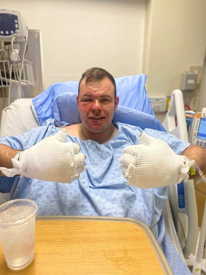 Jesse Humphrey suffered major burns in a house fire in Strathcona County.