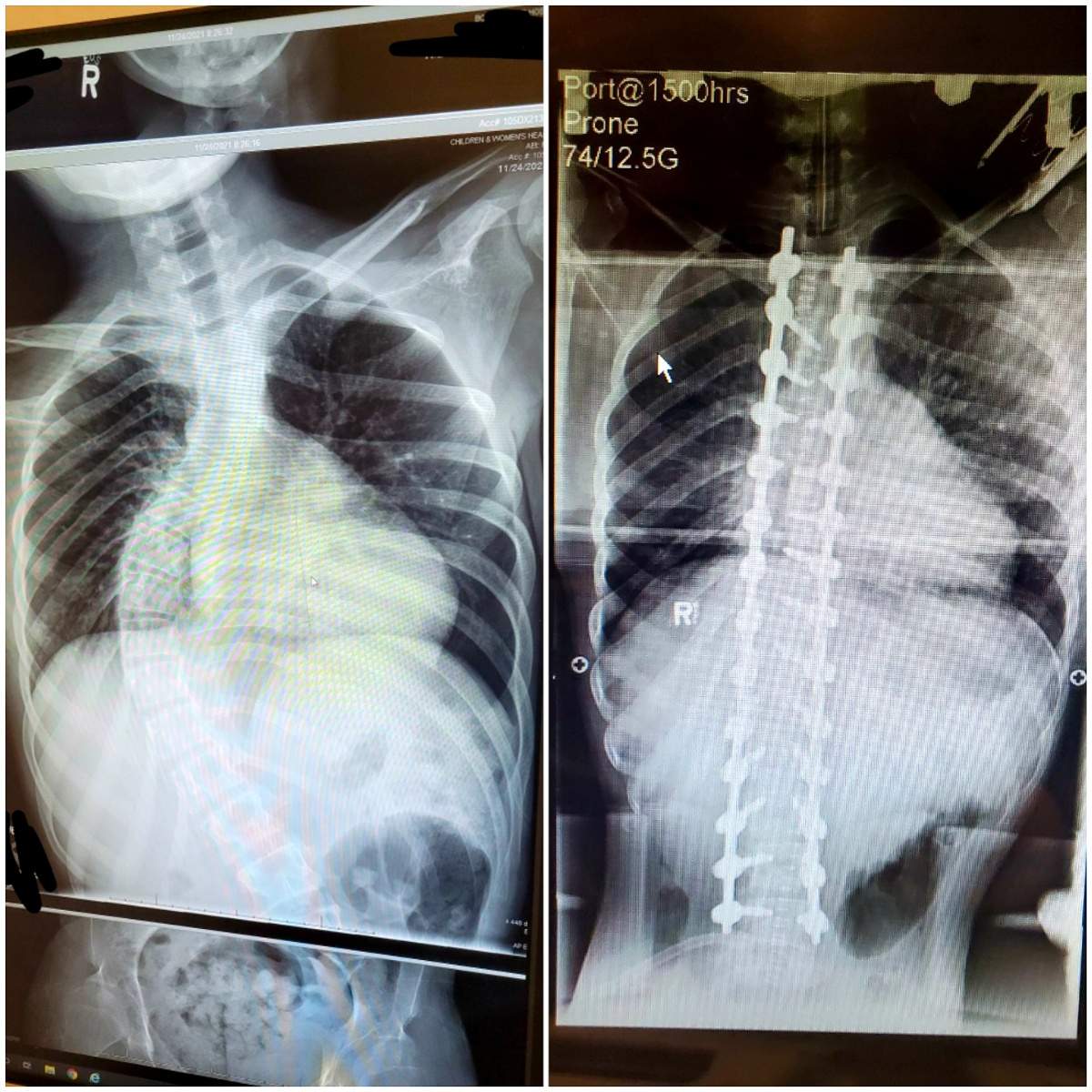 Devin Gallant x-rays