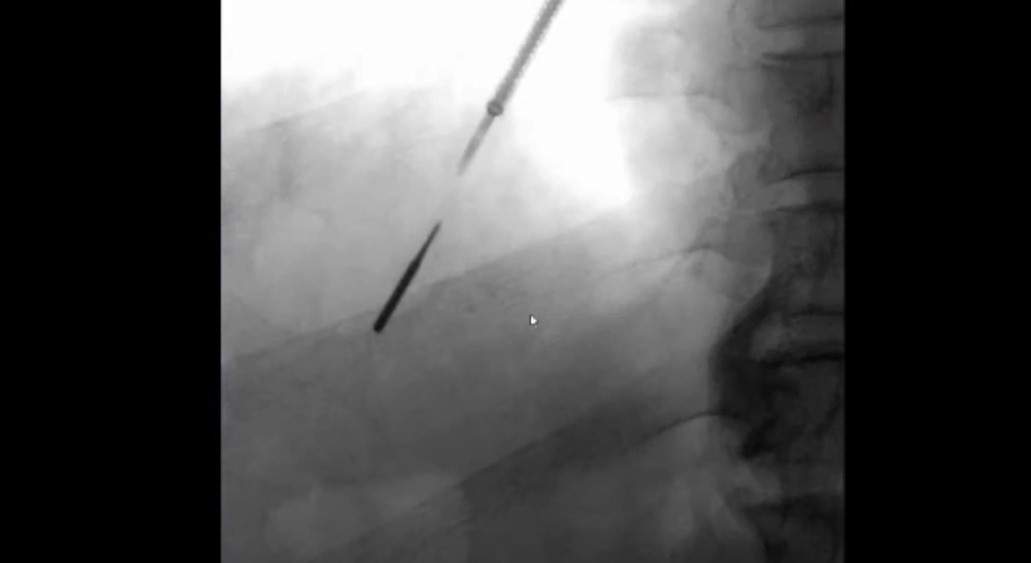 An x-ray showing the catheter and drill bit in the lung.