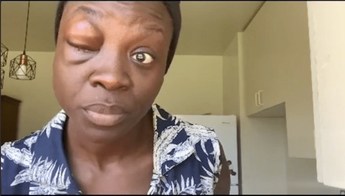 Screen shot of video from Sarah Soyemi showing her injuries after she said she was punched by a London police officer during an arrest.