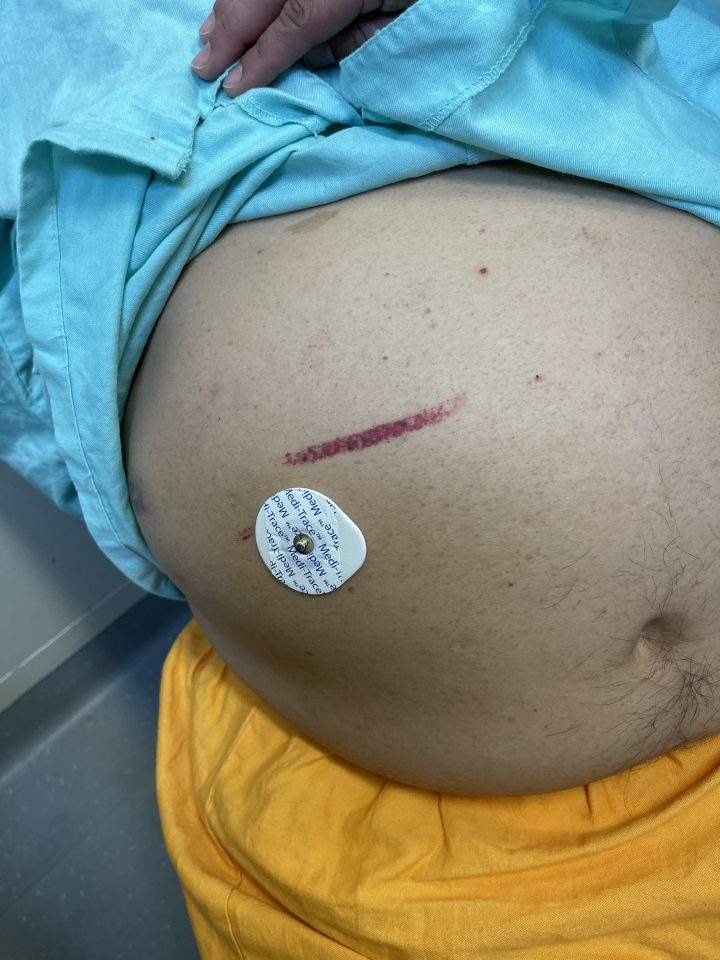 Leo Manson Sr.’s injuries after he was allegedly strapped to his hospital bed.