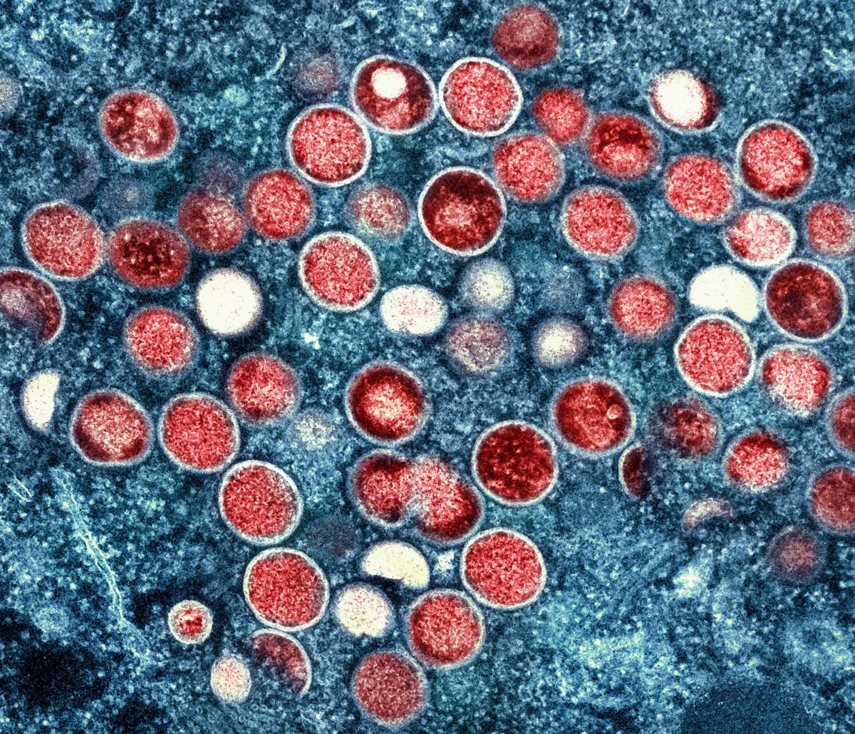 Monkeypox Canada