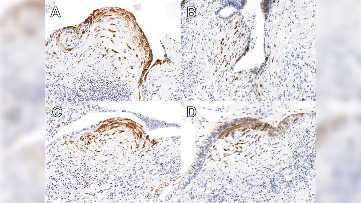 According to a media release from Lawson Health Research Institute, a protein called cyclin-dependent kinase inhibitor protein (p16) in biopsy tissue may help more accurately identify Idiopathic pulmonary fibrosis [IPF].
