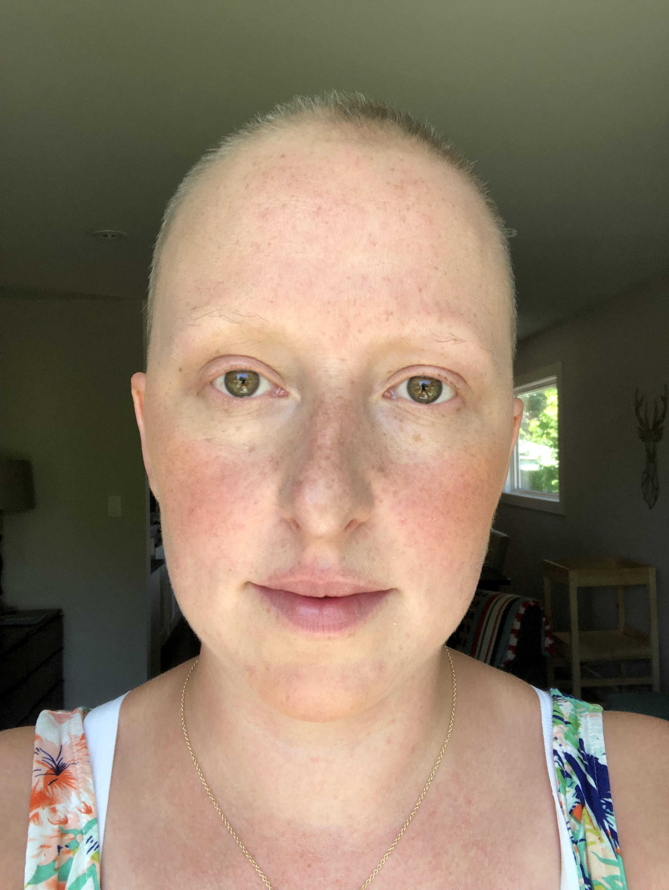 At my lowest point, both physically and mentally, during my initial cancer treatment in 2019. I had lost all my facial hair and was very sick from the accumulated chemotherapy.