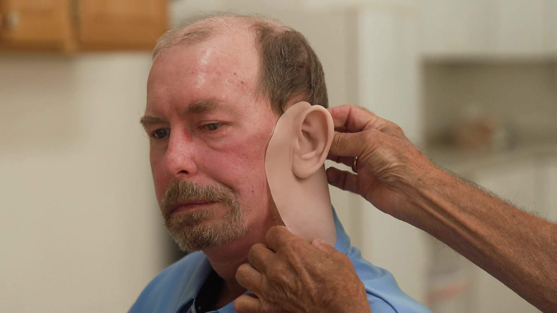 Robert Barron attaches prosthetic ear and skin to cancer survivor Steve Butler.