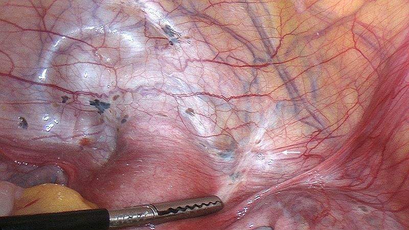 A case of superficial endometriosis is seen in a patient.