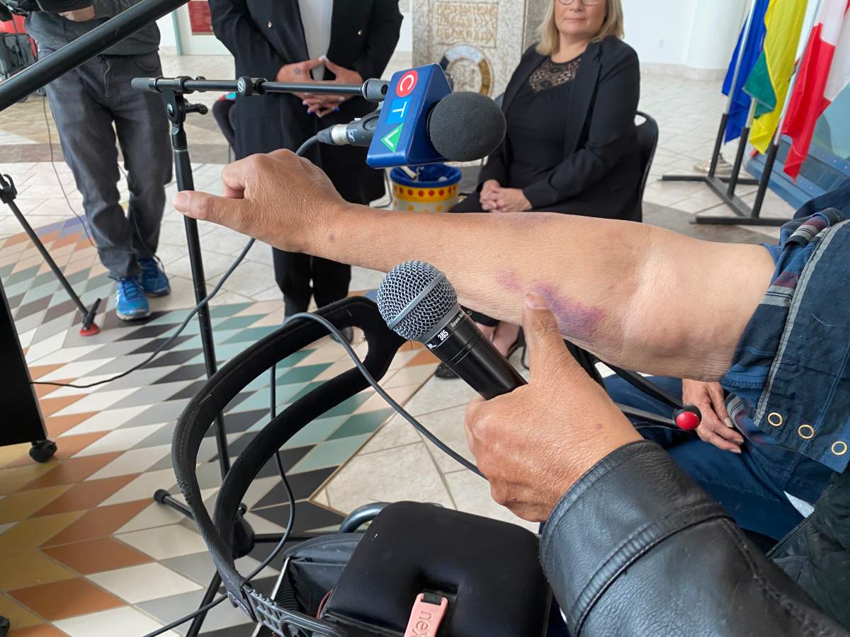Another bruise on Favel’s arm as he told his story at the press conference at First Nations University