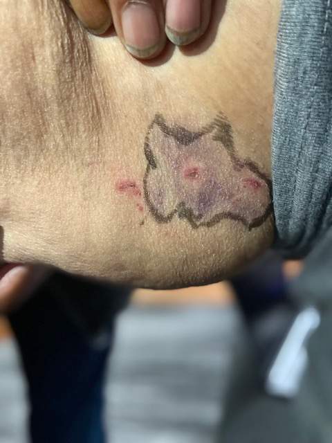 Thomas Favel’s bruises from the alleged assault at Regina General Hospital