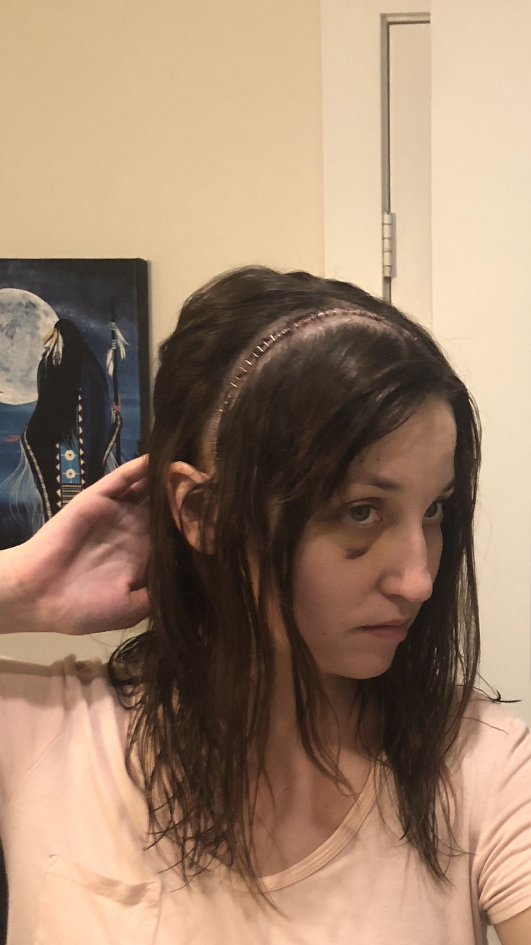 Rebecca Grundy shows off the results of her surgery.