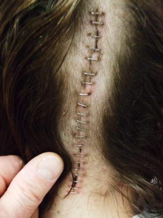 Staples can be seen along the incision Johanna Stuehrenberg endured to remove a brain tumour.