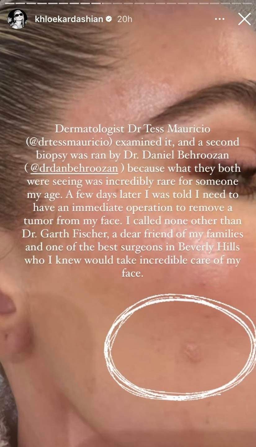 A close-up of the tumour on Khloe Kardashian's face.