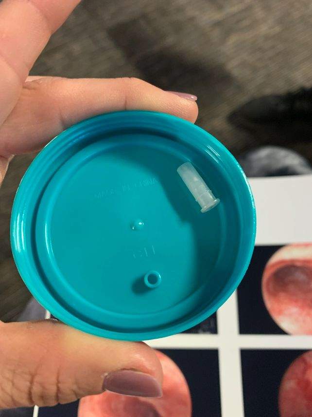 A picture of the squeaker that was removed from Johnathan Serrano's esophagus.