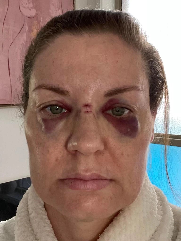 Rebecca Howe, whose face is covered in bruises reportedly obtained when she was hit with a microphone thrown by Axl Rose.