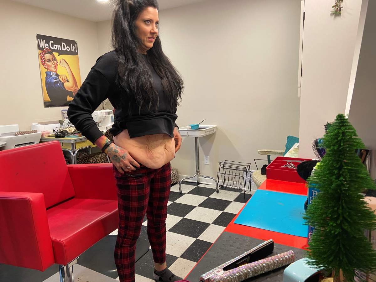 Georgina shows her excess skin.