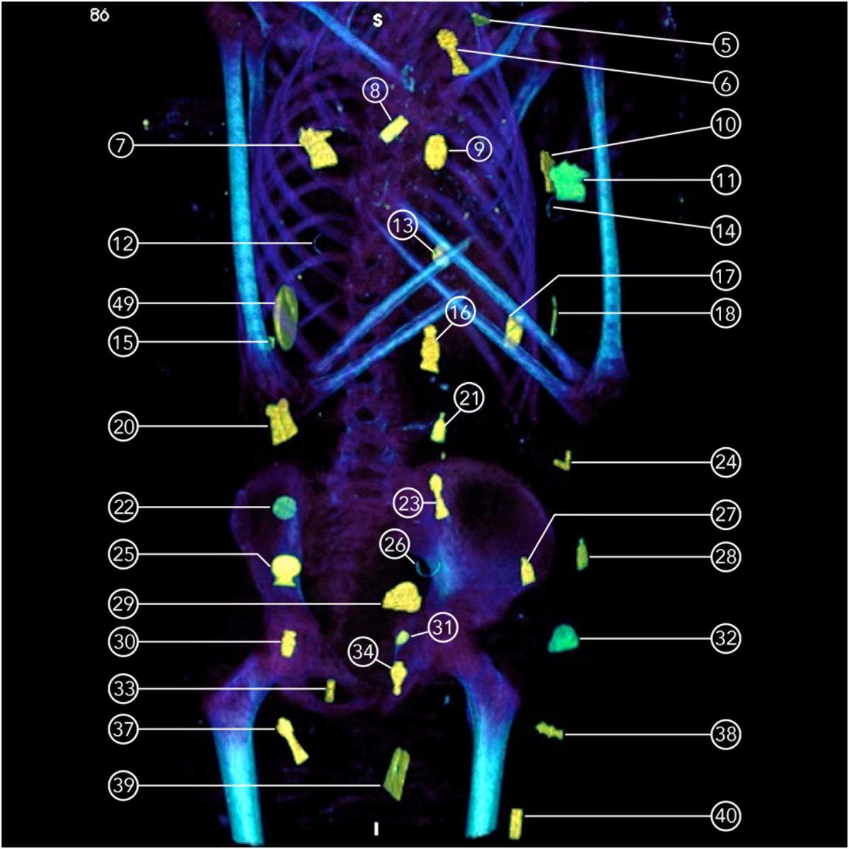 Thick slab CT image of the torso of mummy showing amulets placed on the mummy’s surface and between the wrappings.