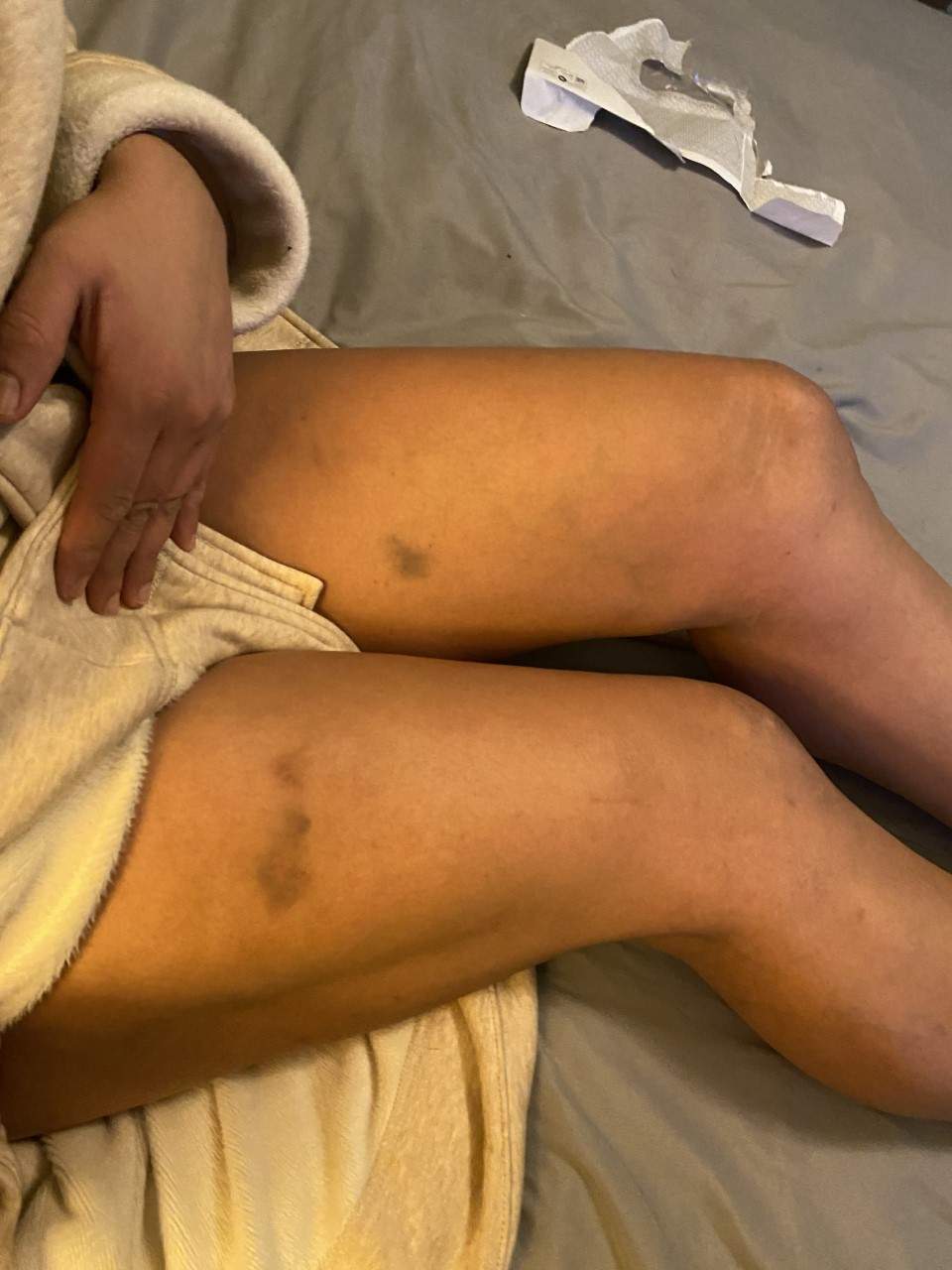 Lisa Adams said she sustained bruising in the attack.