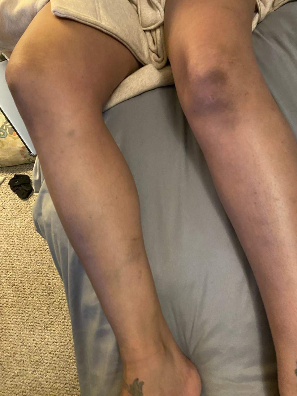 Lisa Adams said she sustained bruising in the attack.