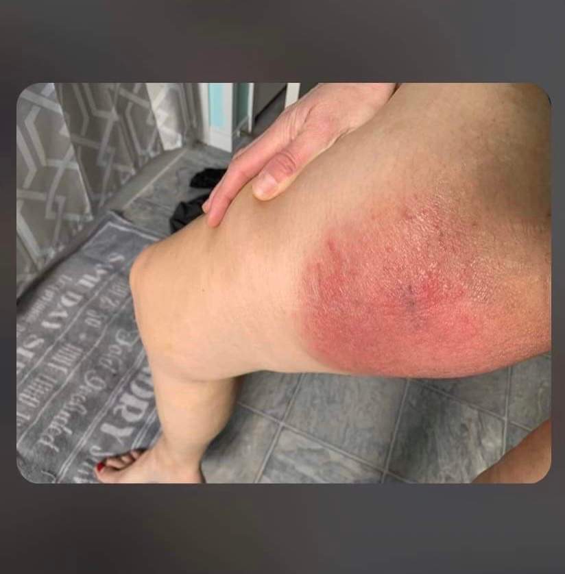 A photo of the rash on Laura Landry-Rudolph’s thigh taken in early 2023.